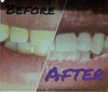 Teeth Whitening Services  *-downpayment*