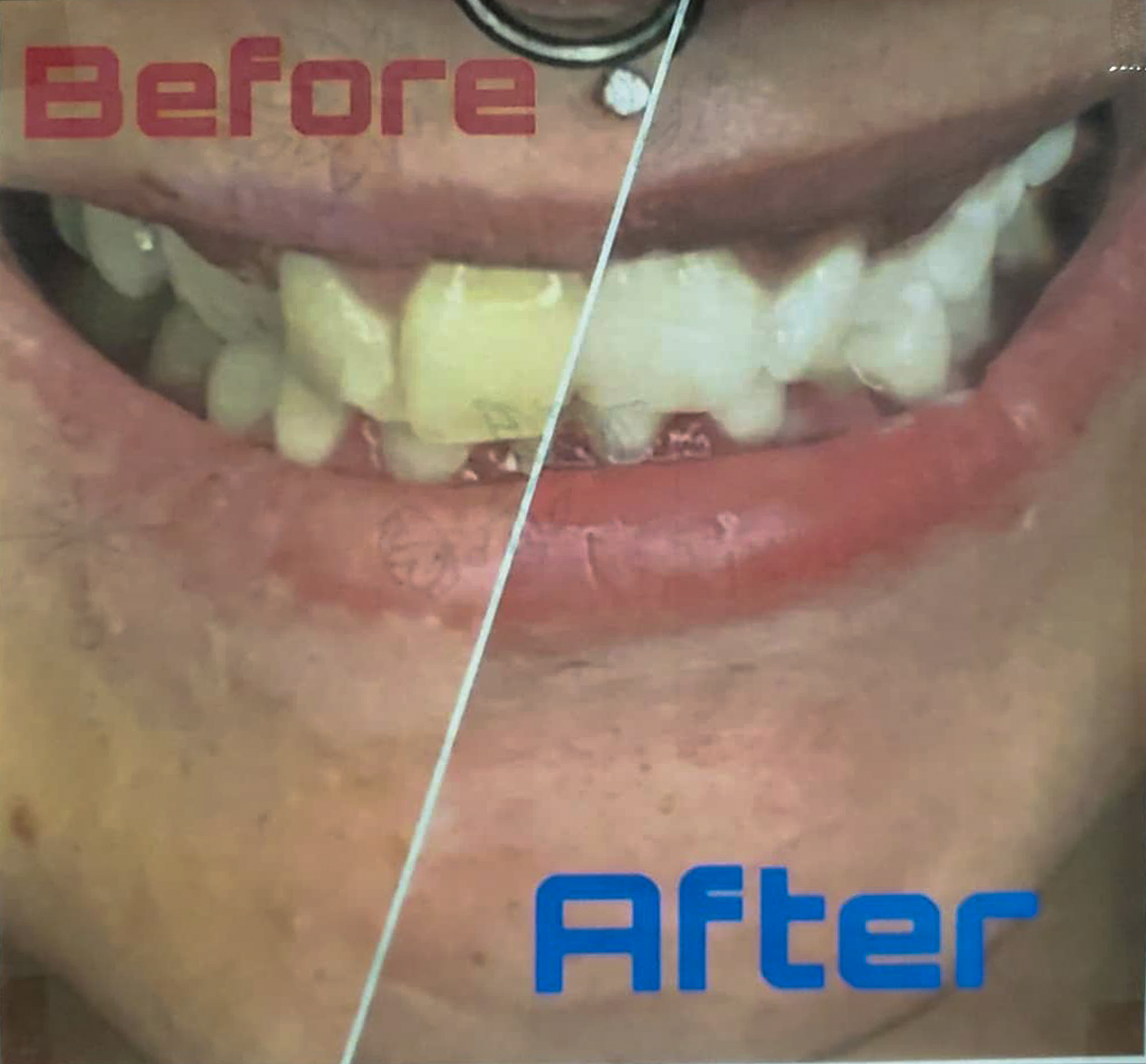 Teeth Whitening Services  *-downpayment*