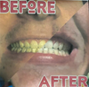 Teeth Whitening Services  *-downpayment*