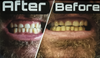 Teeth Whitening Services  *-downpayment*